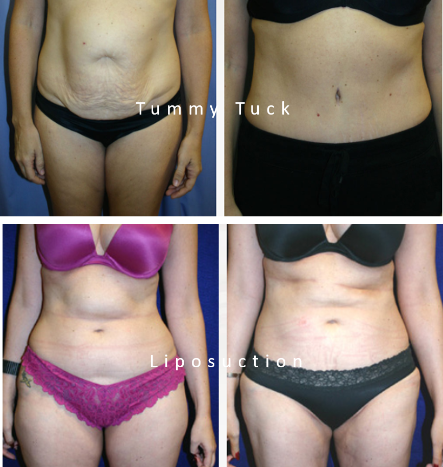 Tummy Tuck vs. Liposuction - Weider Plastic Surgery