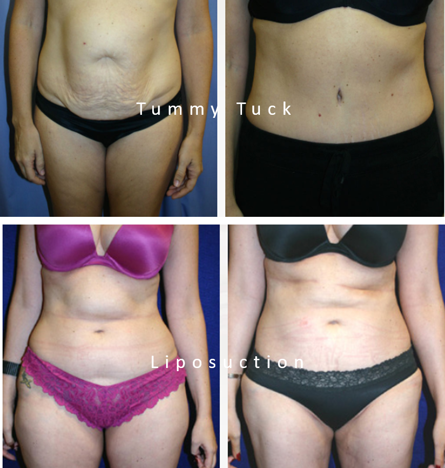 What are The Differences Between a Liposuction and Tummy Tuck